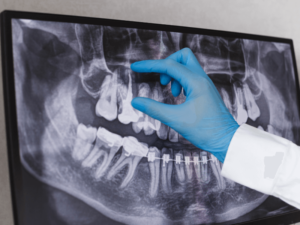 radiografia de dente