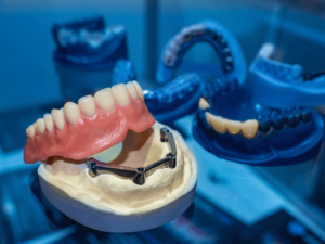 tipos de implantes dentários