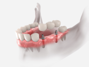 tipos de implantes dentários